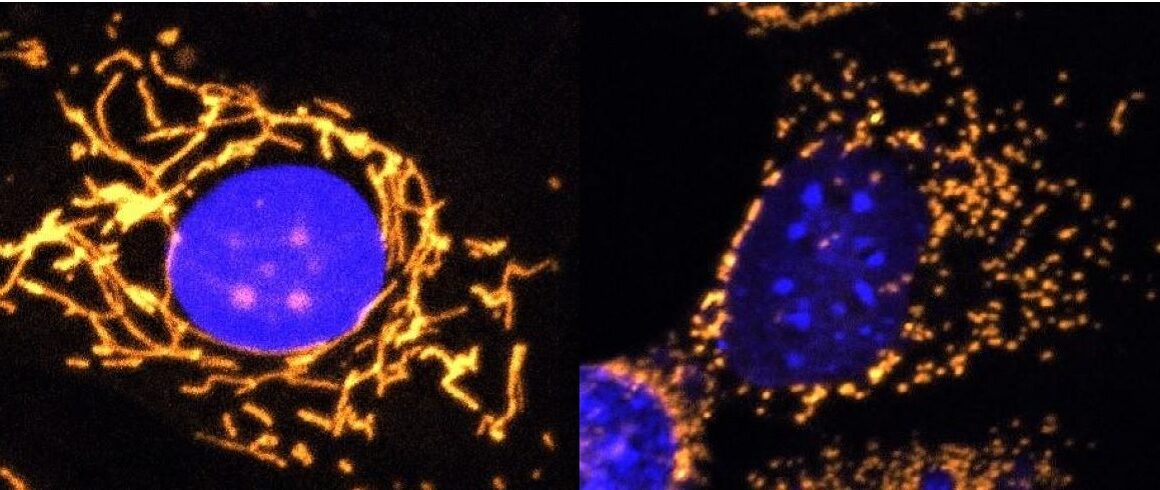 Healthy cell and cell lacking OPA1 protein Left: Fluorescent microscope image with mitochondria highlighted in gold. This healthy cell shows a highly elaborate and well-connected network of mitochondria. Right: Fluorescent microscope image with mitochondria highlighted in gold. This cell completely lacks OPA1 protein and shows fragmented mitochondria. ©Professor Jane Farrar and Dr Daniel Maloney, Trinity College Dublin