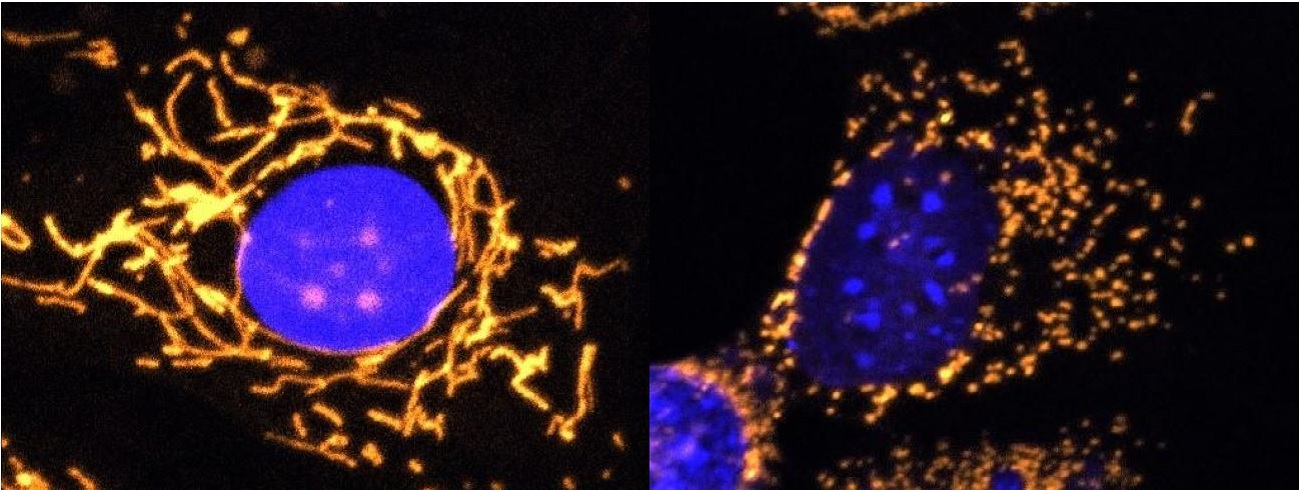 Healthy cell and cell lacking OPA1 protein Left: Fluorescent microscope image with mitochondria highlighted in gold. This healthy cell shows a highly elaborate and well-connected network of mitochondria. Right: Fluorescent microscope image with mitochondria highlighted in gold. This cell completely lacks OPA1 protein and shows fragmented mitochondria. ©Professor Jane Farrar and Dr Daniel Maloney, Trinity College Dublin