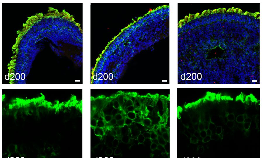 Treating patient-derived retinal organoids with AAV-NPHP5 restores rhodopsin localization in photoreceptor outer segments. Top: Retinoids stained for DNA (blue), NPHP5 (red), and rhodopsin (green). Below: Close-up view of organoid photoreceptor layer stained green for rhodopsin. Adapted from Kruczek et al, 2022. © Anand Swaroop, Ph.D. and Kamil Kruczek, Ph.D., National Eye Institute