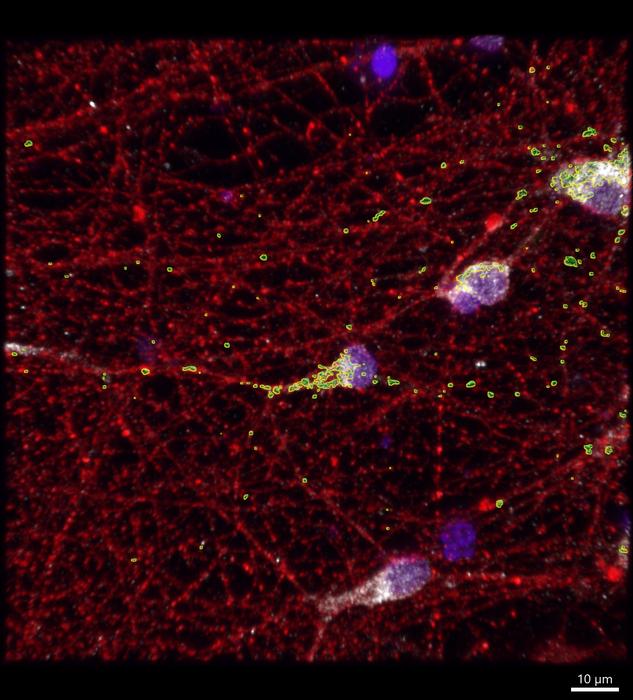 Mitochondria (shown in green) aren’t working as they should in the neurons (shown in red) of people with FXS. Researchers have identified a gene involved in this mitochondrial dysfunction, as well as a potential treatment. ©Minjie Shen, University of Wisconsin–Madison.